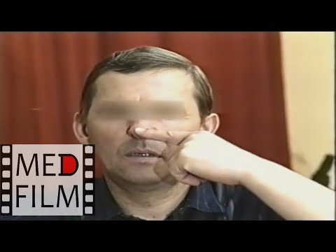 Видео: Сенситивная атаксия © Sensitive ataxia