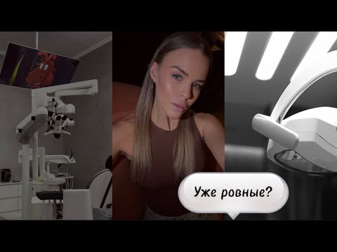 Видео: 2 МЕСЯЦА С БРЕКЕТАМИ