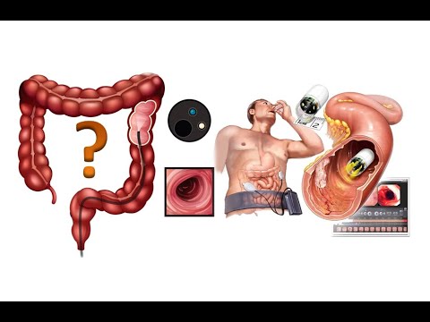 Видео: Чем заменить колоноскопию?