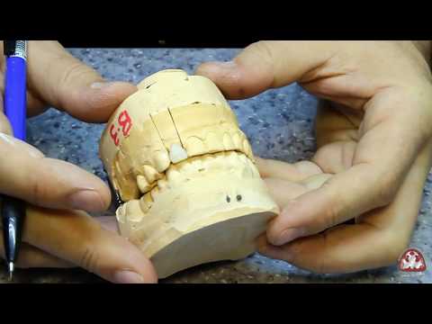 Видео: ЗУБ ПО РИЧМОНДУ КОМПОЗИТ