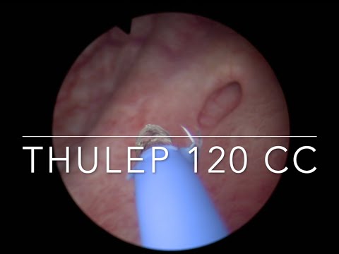 Видео: Thulep 120 cc лазерная энуклеация аденомы простаты