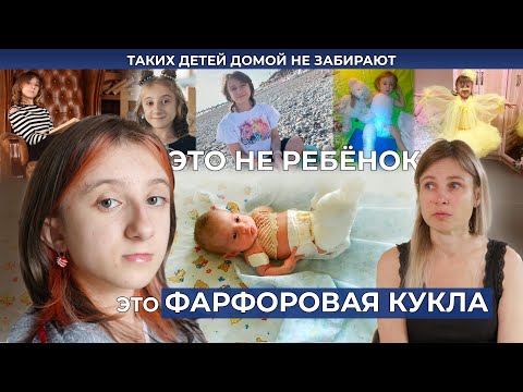Видео: НЕСОВЕРШЕННЫЙ ОСТЕОГЕНЕЗ | История Ульяны Шибиной