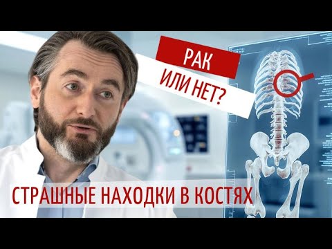 Видео: 3 пугающих диагноза. Находки в костях после КТ
