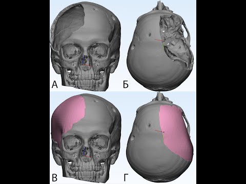 Видео: Моделирование краниоимпланта Materialise Mimics 17.0. Materialise Matic 9.0
