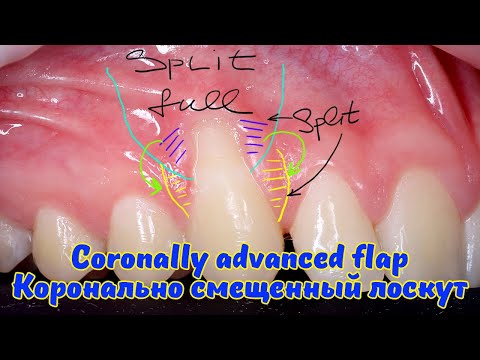 Видео: Лечение рецессии десны методом КСЛ // Coronally advanced flap for single gum recession treatment