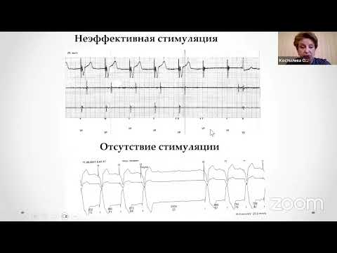 Видео: Основы электрокардиостимуляции: мостик к пониманию работы имплантируемых устройств
