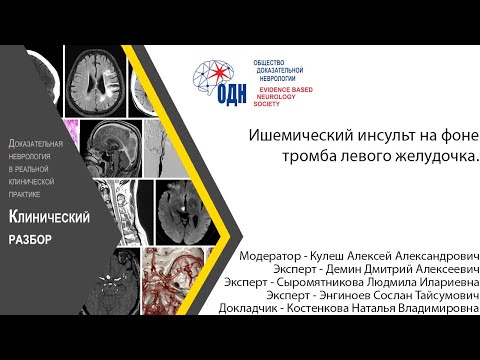 Видео: Ишемический инсульт на фоне тромба левого желудочка.