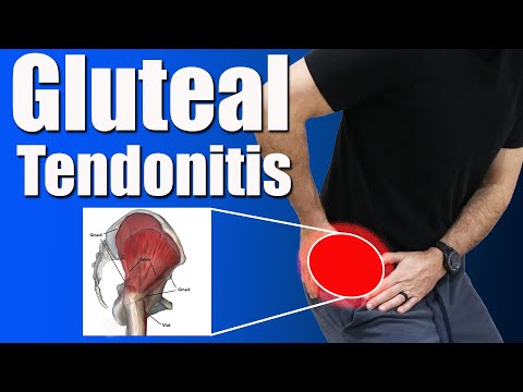 Видео: Тендинит ягодичных мышц: симптомы, причины и эффективные упражнения при боли в большом вертеле