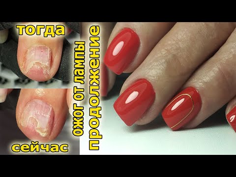 Видео: ❤ ОЖОГ от ЛАМПЫ ❤ ПРОДОЛЖЕНИЕ ❤ реконструкция ногтя ❤ РЕМОНТ ногтя ГИБКАЯ ❤ ЛЕНТА на ногтях ❤