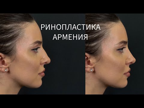 Видео: Решилась на Ринопластику