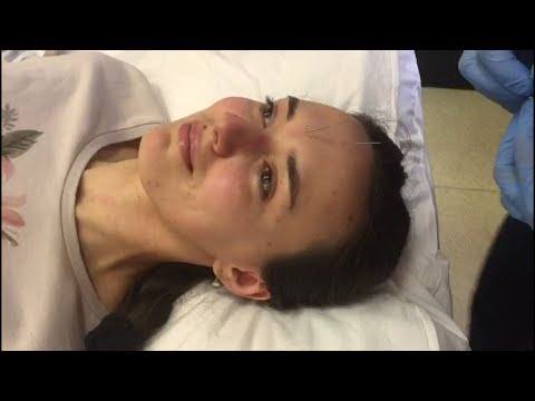 Видео: Естественное омоложение без пластики и инъекций. В чем эффективность иглотерапии лица?