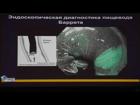 Видео: 25 Видяева НС Пищевод Барретта