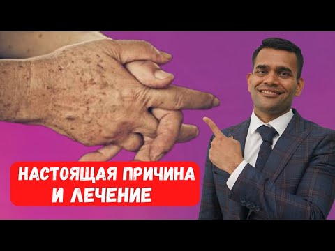 Видео: Пигментные Пятна/ Печёночные Пятна / Гиперпигментация - Как Их Удалить И Реальная Причина