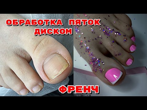 Видео: ПЕДИКЮР 🦶ОБРАБОТКА ПЯТОК ДИСКОМ 🦶 ФРЕНЧ НА НОГАХ