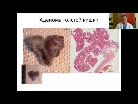 Видео: Введение в онкопатологию