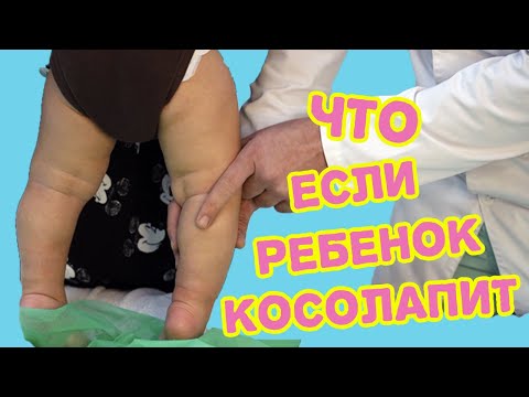 Видео: Ребенок косолапит. О-образные ноги. (Варус ног)