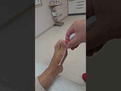 Видео: Отзив 13 дни след миниинвазивна корекция на халукс валгус. Другото ходило е оперирано по стар метод!