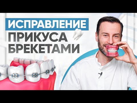 Видео: Исправление прикуса брекетами. Виды брекетов, цена, установка, этапы и снятие