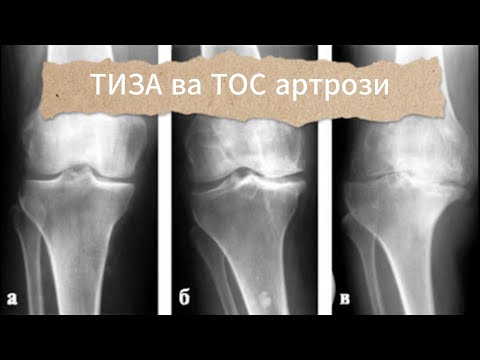 Видео: АРТРОЗНИ НИМА УЧУН ДАВОЛАЙ ОЛИШМАЙДИ? #артроз #кинезиологиятошкент #остеохондроз #грижа