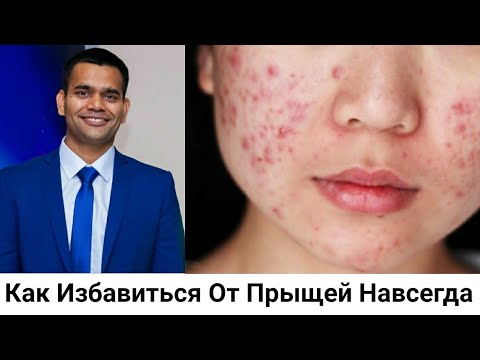 Видео: Как Избавиться От Прыщей Навсегда| Доктор Вивек