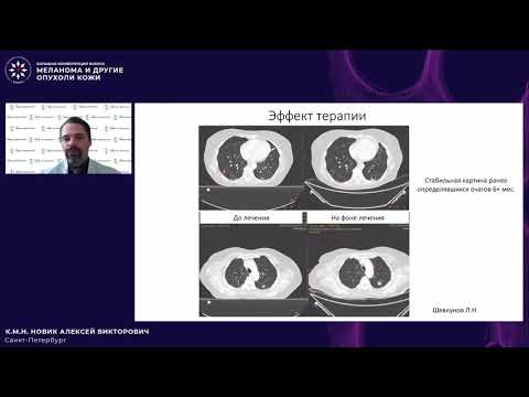 Видео: Меланома и другие опухоли кожи: в поисках оптимальных решений (панельная дискуссия) Кл. случай 4