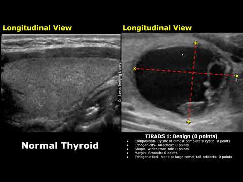 Видео: Классификация узлов щитовидной железы по данным УЗИ ACR TIRADS | Система отчётности и данных по в...