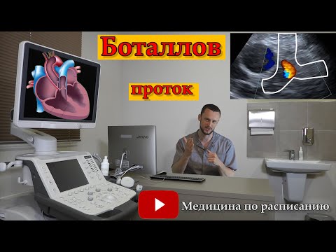 Видео: Открытый артериальный проток, Боталлов проток.