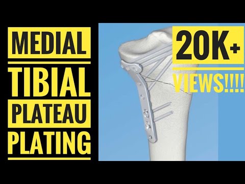 Видео: Медиальный доступ и остеосинтез медиального мыщелка большеберцовой кости