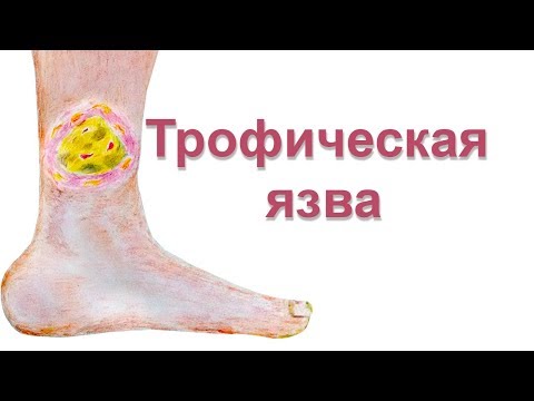 Видео: Трофическая язва