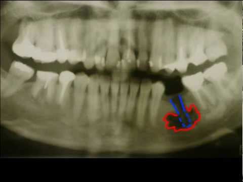 Видео: Что такое остеомелит?