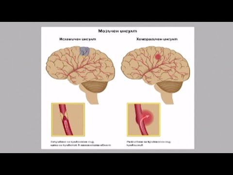 Видео: Мозъчни инсулти исхемични и хеморагични