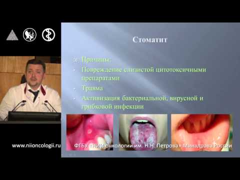 Видео: Уход за полостью рта у онкологических больных на этапе лечения и реабилитации. Ульянов А.В.
