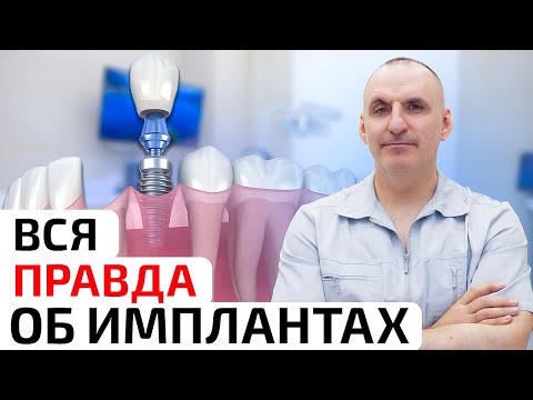 Видео: Зубные импланты: мифы, правда и реальные преимущества