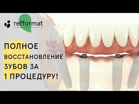 Видео: 🤔 Как проходит имплантация зубов все на 4. Имплантация зубов все на 4. 12+