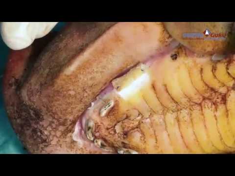 Видео: Методика пластики  мягких тканей «Апикально смещенный  лоскут»