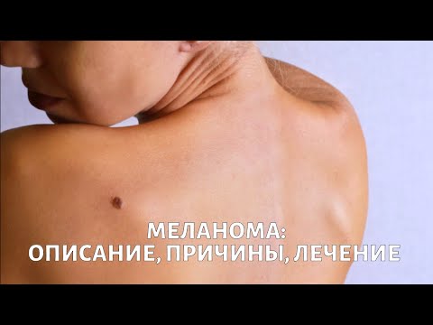 Видео: Меланома. Вопросы выживания
