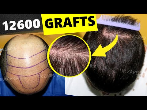 Видео: Доктор Зарев — Лучшие результаты FUE для NW 5 - NW 7
