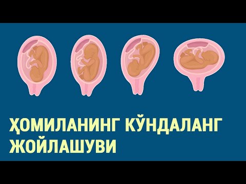 Видео: Ҳомиланинг кўндаланг жойлашуви
