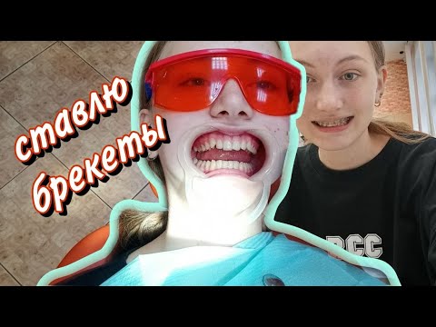 Видео: СТАВЛЮ БРЕКЕТЫ!!!😮😮 Больно? Странно? Неприятно? #брекеты