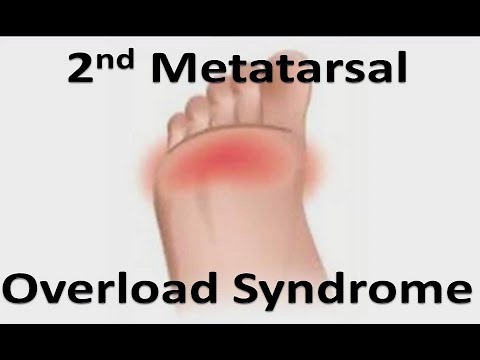 Видео: Синдром предвывиха 2-го пальца стопы *Лечение на дому*