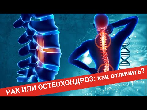 Видео: РАК И ОСТЕОХОНДРОЗ: как отличить?