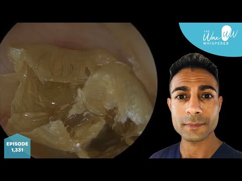 Видео: 1,331 - Мильфей из омертвевшей ороговевшей кожи, снятой с уха