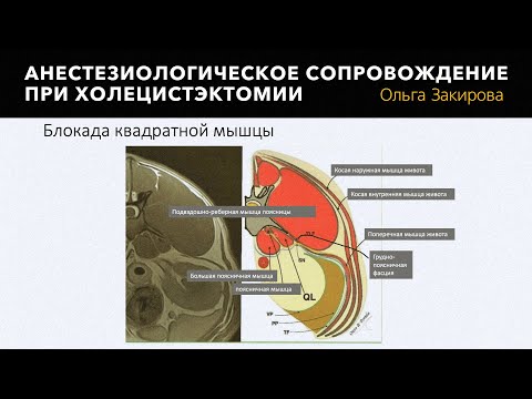Видео: Анестезиологическое сопровождение при холецистэктомии