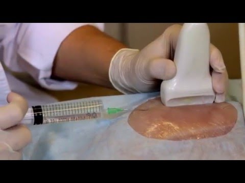 Видео: Вакуумная Аспирационная Биопсия - Учебный фильм (Одинцов В.А., Клиника Одинцова)