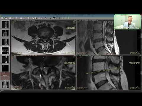 Видео: Изменения на МРТ позвоночника за 10 лет. Разбор реального клинического случая