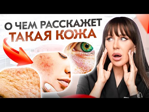 Видео: Прыщи, дерматит, псориаз, розацеа. Что кожа расскажет о твоем кишечнике?