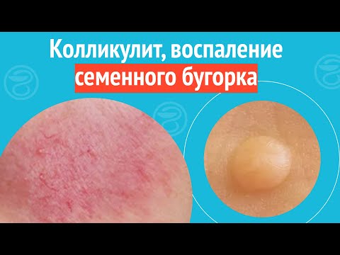 Видео: 😨 Колликулит, воспаление семенного бугорка. Клинический случай №1666