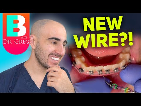 Видео: Подтяжка брекет-системы: почему и как ортодонт меняет брекет-систему