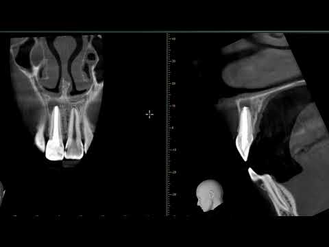 Видео: Оценка периодонтита на 3д кт снимке зубов в стоматологии