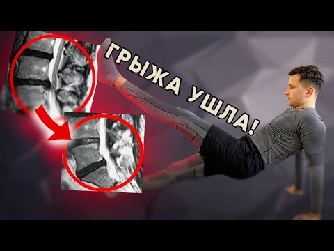 Видео: Как я ВЫЛЕЧИЛ грыжу самостоятельно. Универсальный комплекс упражнений